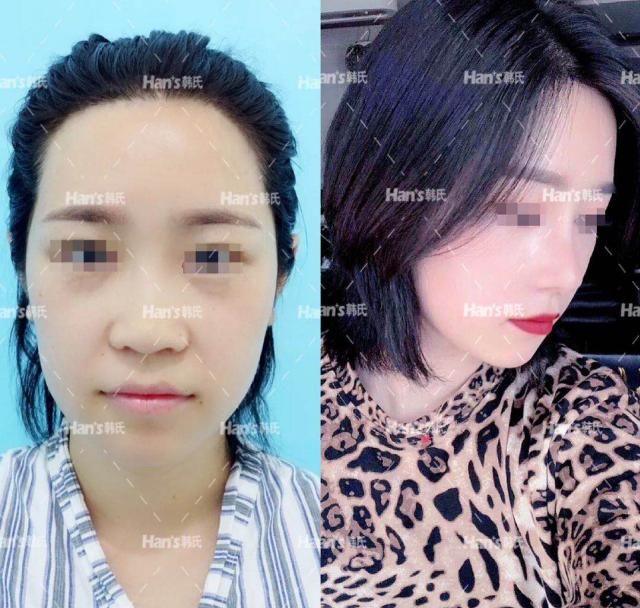  『做出来的鼻』隆鼻有后遗症吗？可以捏鼻子做猪鼻子动作吗？