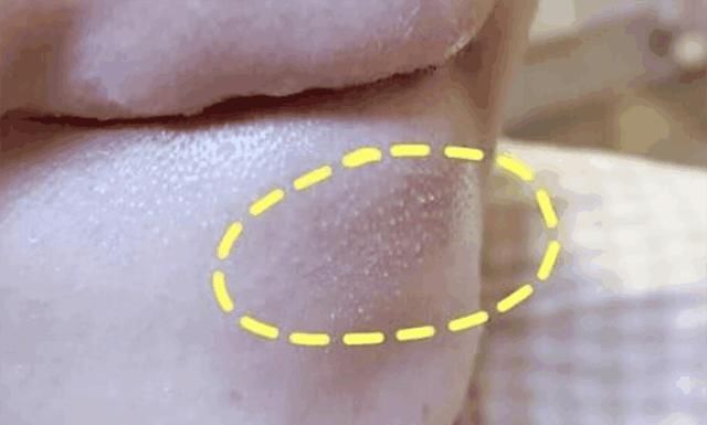 抿嘴后下巴毛孔凸起“白米粒”! 清除用2招就好