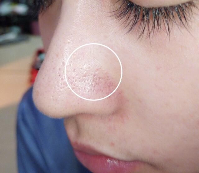 鼻子挤出的小颗粒太多，是螨虫的排泄物凝固，怎么让它们不再长？