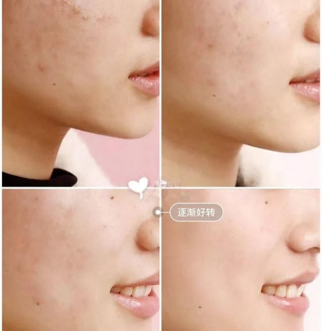  #毛孔粗大#是不是30岁之后,女人的皮肤就开始走下坡路了?