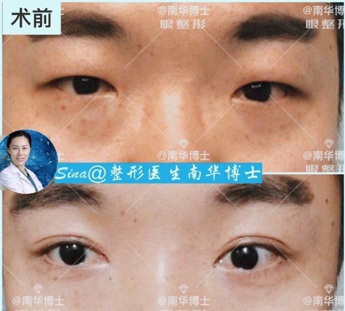 「眼部」双眼皮除了好看,还能改善哪些眼部问题?