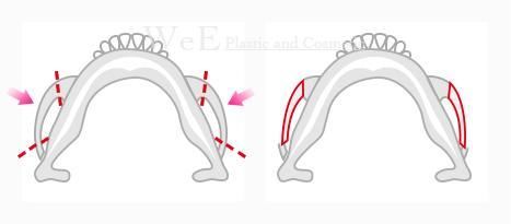 张笑天:高颧骨显老怎么办?内推就好