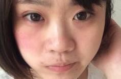  口罩|戴口罩长一脸痘痘怎么办？这些祛痘痘的方法可以让你快速祛痘痘