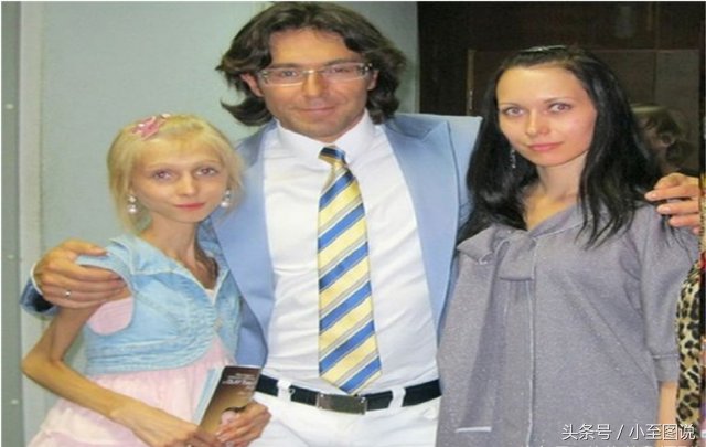 俄罗斯女子为减肥变成活骷髅，体重只剩42斤