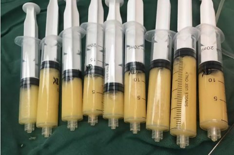  「自体脂肪移」还在嫌弃脂肪“油腻”？那是因为你没有物尽其用