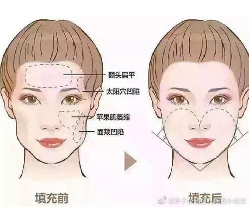  『脂肪细胞』脂肪填充多久能消肿？