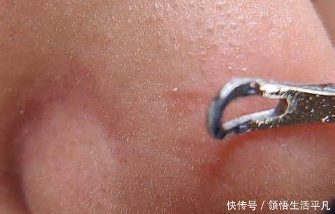 『白色东西』鼻子上挤出来的白色物体是什么皮肤科医生给出这些忠告