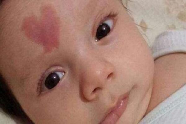 宝宝为什么会有胎记?孕妈在孕期这些因素,容易