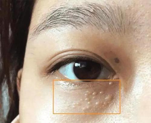 眼睛周边隐藏的“白颗粒”，竟是这3物, 对付它们2招既能清干净