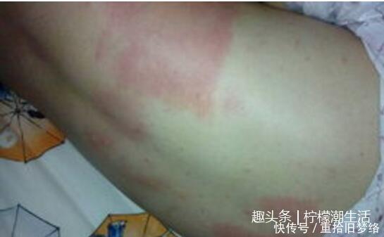 单身男子身上总发痒 医生让他剪掉被褥 看到结果难以启齿 雪花新闻 单身男子身上总发痒 医生让他剪掉被褥 看到结果难以启齿 雪花新闻