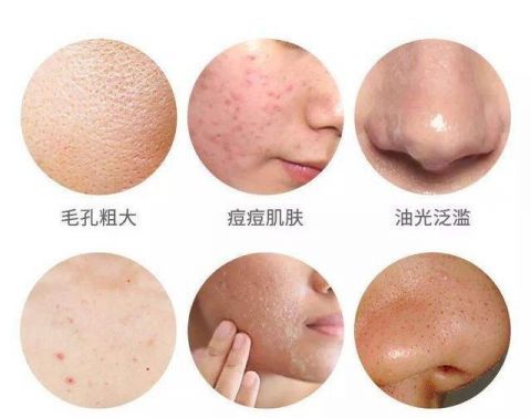  【黑头和痤疮】黑头和粉刺是有区别的，千万不要混为一谈，可惜很多人都不知道