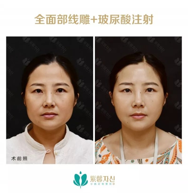 苏州紫馨逆龄术--让年龄成为秘密,悦升线苏州区首发