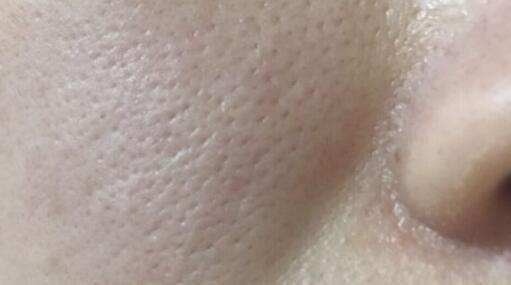 皮肤不会喊痛, 但如果出现这几个征兆, 说明脸上螨虫已经躲不住了