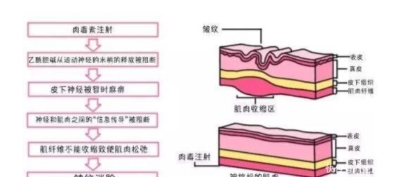 尿酸@面部除皱采用玻尿酸和肉毒素,两者的不同之处