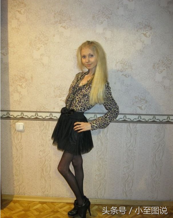 俄罗斯女子为减肥变成活骷髅，体重只剩42斤