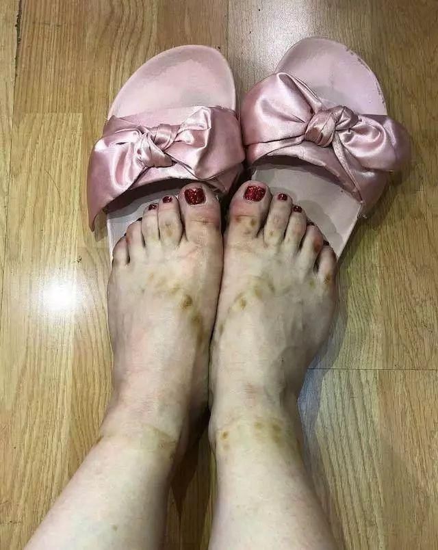 穿高跟鞋有多辛苦?冉莹颖脚被勒出印，她的脚趾变形
