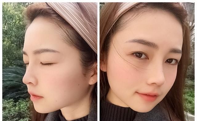  #术后#隆鼻真的有用吗？鼻综合术后六个月记录，这完全不是一个人！