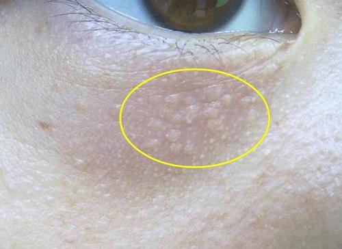 眼睛周边隐藏的“白颗粒”，竟是这3物, 对付它们2招既能清干净