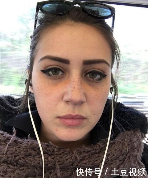 『手术』英女子痴迷梅根“雀斑妆”,拙劣手术让面部毁容,花3万治疗修复