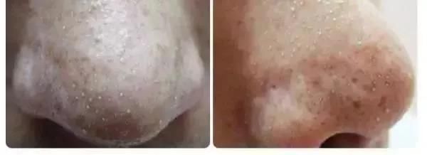 黑头粉刺+毛孔粗大?这份良心祛黑头指南收好了!