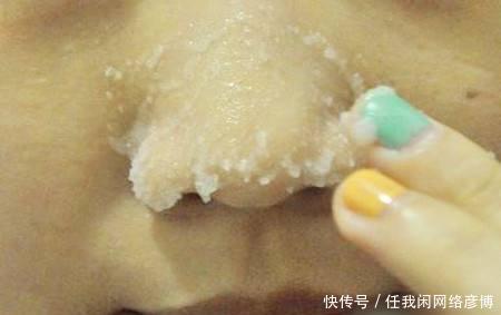 # 黑头#黑头乖乖跑出来，鼻子挤出来的“黄色条物”是啥协和医生教你3招