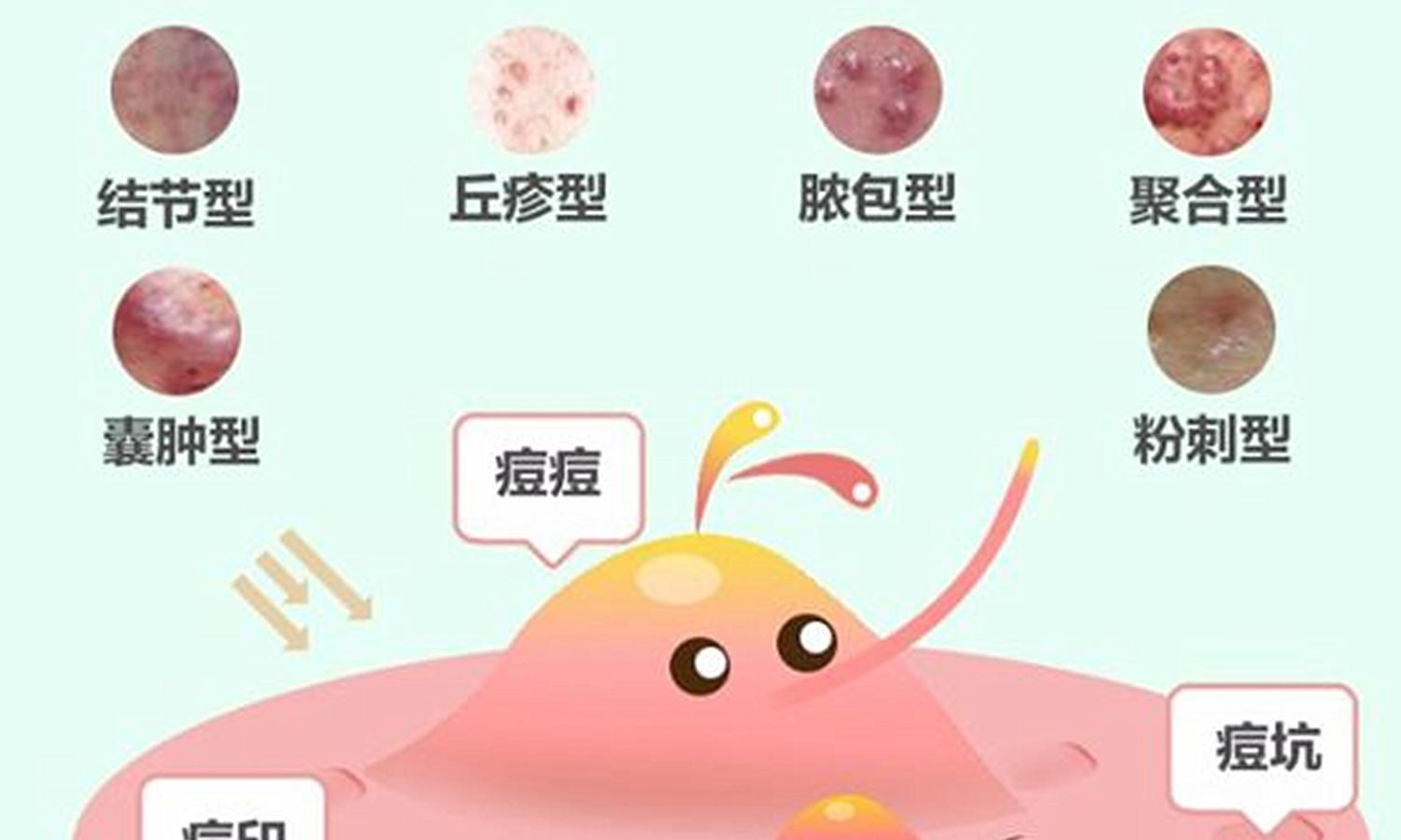  『脸上长』痘痘真不能“挤”？这误会大了，挤痘其实能让痘痘消得更快！
