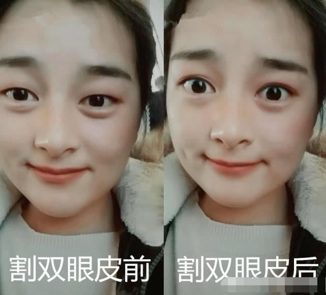 好看|割双眼皮前VS割双眼皮后,看见差距,眼睛变好看了但灵魂没了!