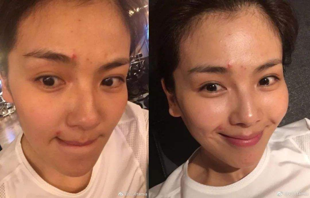 明星也会起痘痘，刘涛起痘后这样做，回到镜头下照样是女神!