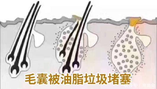  『脱发』先别买买买！剁手前要认清这些让人头秃的真相