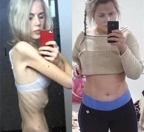 150斤女子因减肥患厌食症，体重剩下70斤，全身上下是骨头!