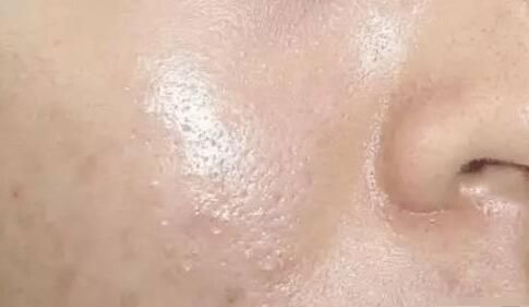  『夏季』壹知肤：油皮就别玩儿命保湿了， 夏季油皮护肤全攻略