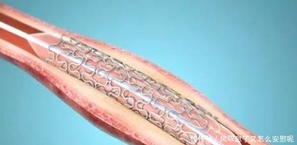 做完心脏支架手术后,还能活多久?心脏血管