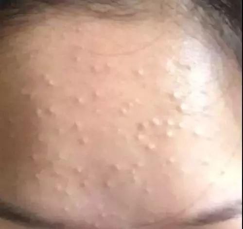 如何去除“闭口粉刺”