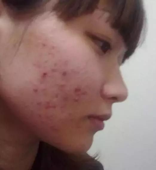 脸上这4个异常，说明已经感染螨虫，再不除螨，脸注定是负担