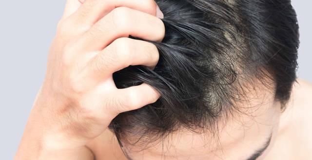  『稀少』头发稀少，多梳头有用吗？怎么做让头发浓密起来