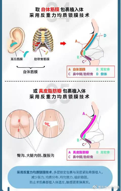 『医生』关于隆鼻术后假体偏斜的原因,你知道吗?