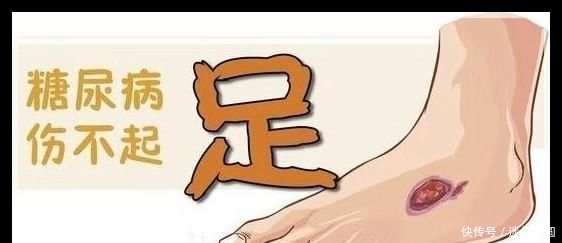  「预防」糖尿病患者记住这些足部管理措施，早期预防糖尿病足