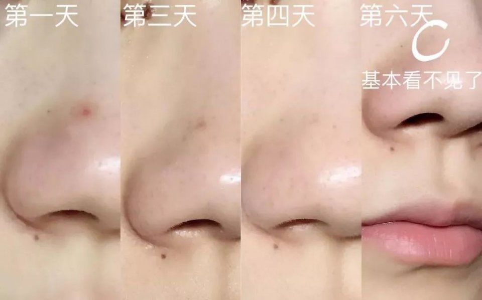 日本祛痘膏竟输给它?第二天痘痘就瘪了，堪比千元修复精华!