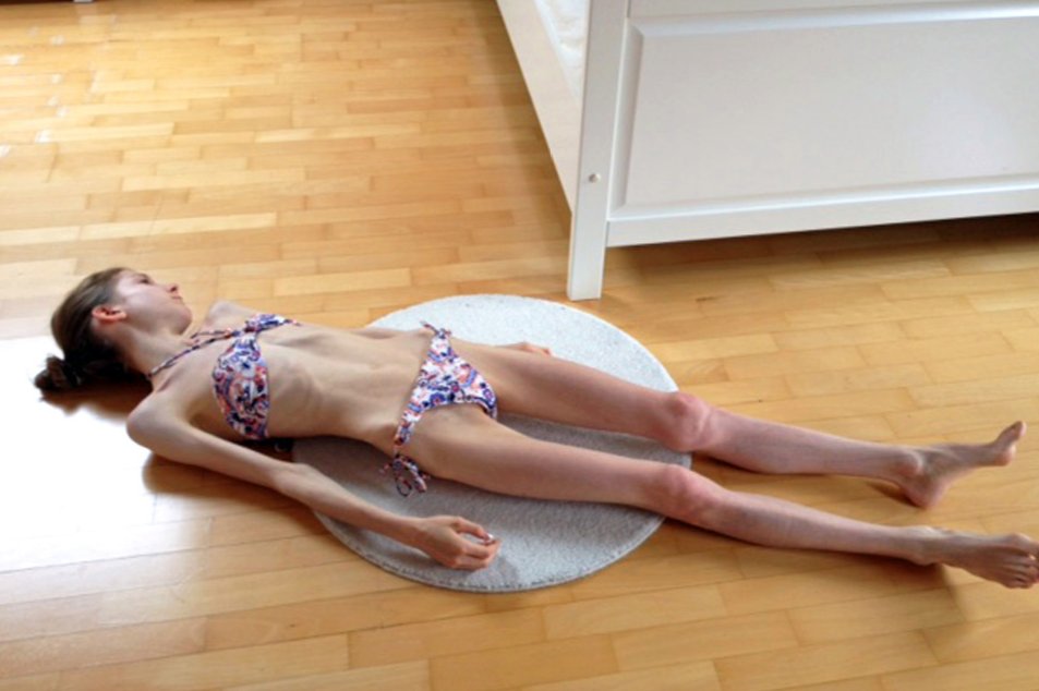 她绝食到21公斤奄奄一息,终成“微胖女神”