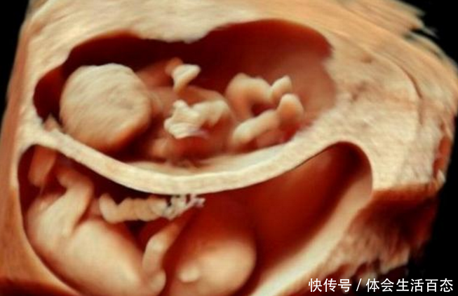 45岁女子试管怀上双胎孕5月却哀求打掉,结果夫