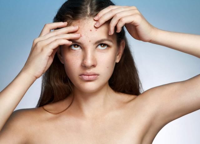 开学季被痘痘“霸占”整张脸的你，洗脸时用点“它”,7天赶跑痘痘