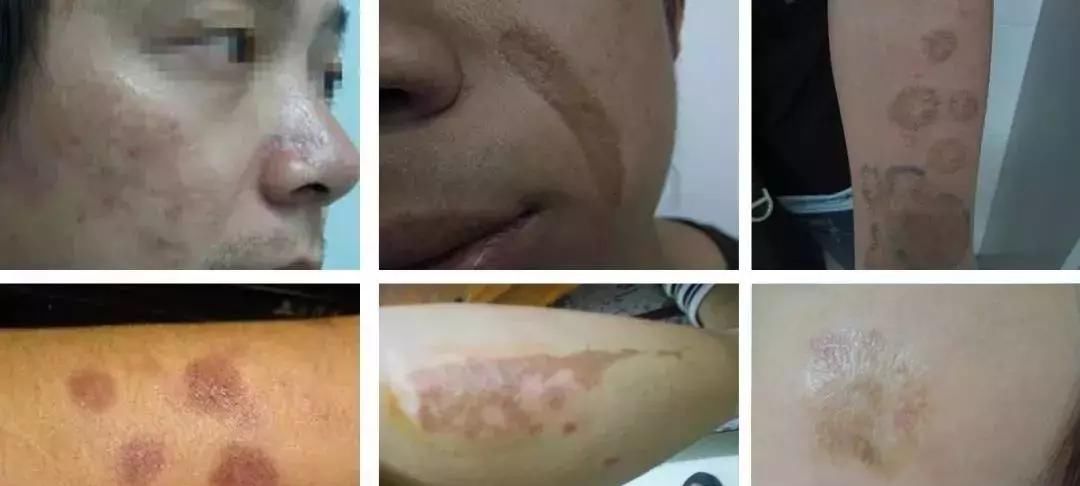 『凸起』为什么疤痕颜色会不断变深?想要恢复正常肤色应该怎么做