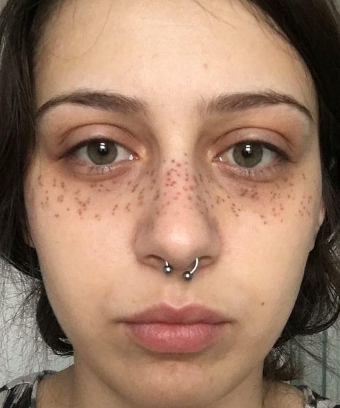  手术：英女子痴迷梅根“雀斑妆”，拙劣手术让面部毁容，花3万治疗修复