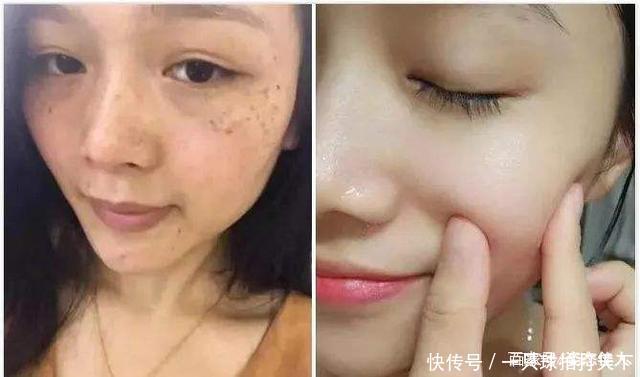 『恢复』皮肤有痘有色斑,赶紧把“花椒”用起来,15天便可恢复肌肤白净!