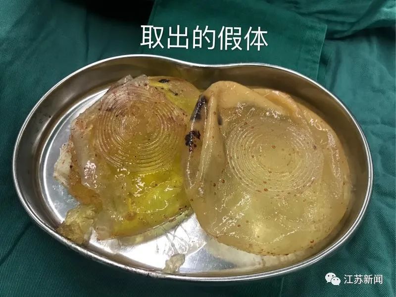  假体■女子30年前隆胸，如今取出这两坨东西…触目惊心！