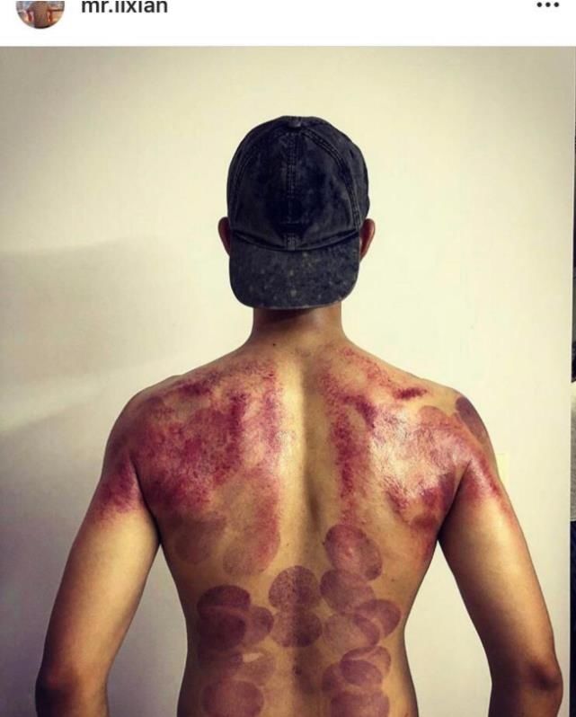  [身体]李现晒拔火罐刮痧后背照，粉丝看完直呼心疼，已经红的发紫