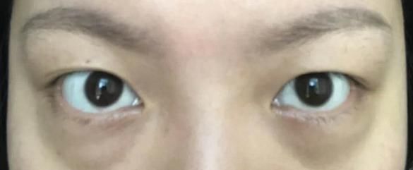 了去■割眼袋多久恢复自然呢?我亲身经历了去眼袋手术恢复的点点滴滴