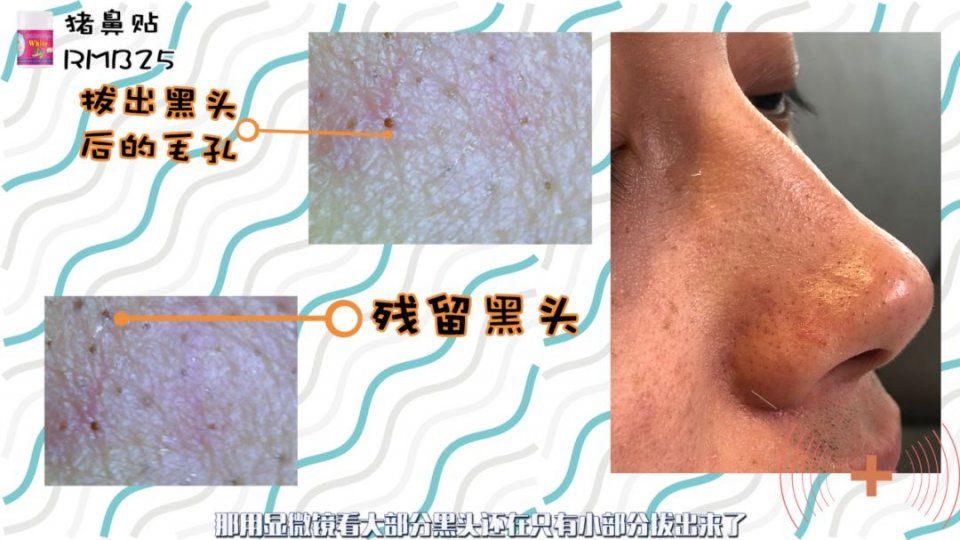 家用去黑头产品测评，这个东西对皮肤的伤害竟然这么大!