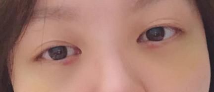 了去■割眼袋多久恢复自然呢?我亲身经历了去眼袋手术恢复的点点滴滴