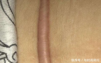  烧伤■烧伤疤痕修复手术多少钱